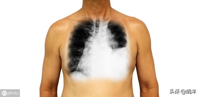 什么样的症状提示肺癌，医生列出7点，每一点都可能是肺癌征兆