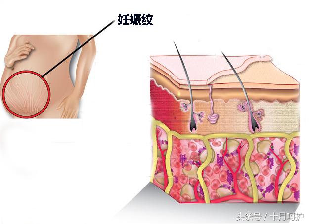 一不小心长了妊娠纹怎么办？这10种方法可以有效缓解和减轻