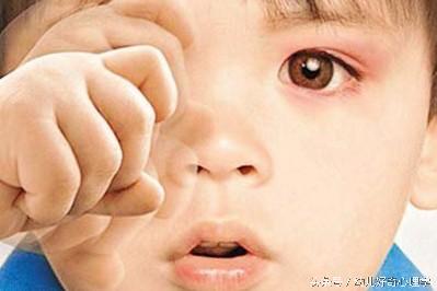 幼儿得了“红眼”怎么办，红眼病吃什么？老中医来支招、、、