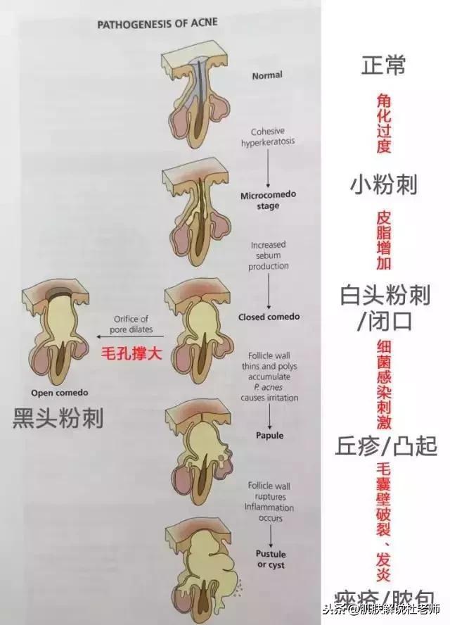 一到冬天，脸上老是冒痘痘？3个土方法，“干掉”痘痘